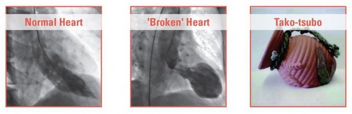“Trái tim tan vỡ” không chỉ là cảm giác